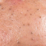 Anti-blackhead